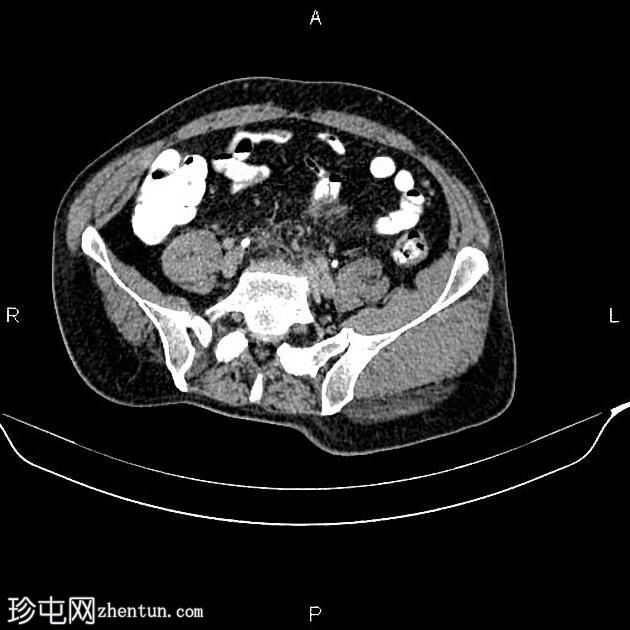 乙状结肠腺癌