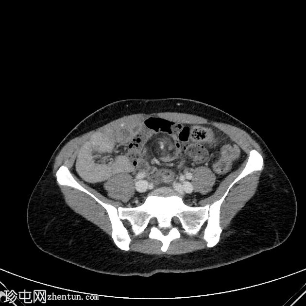 肠系膜的腹旋征（漩涡征）