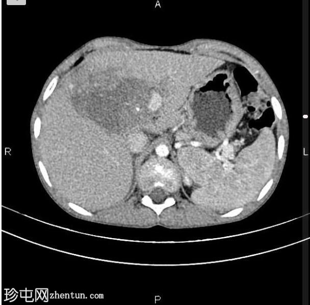 肝母细胞瘤