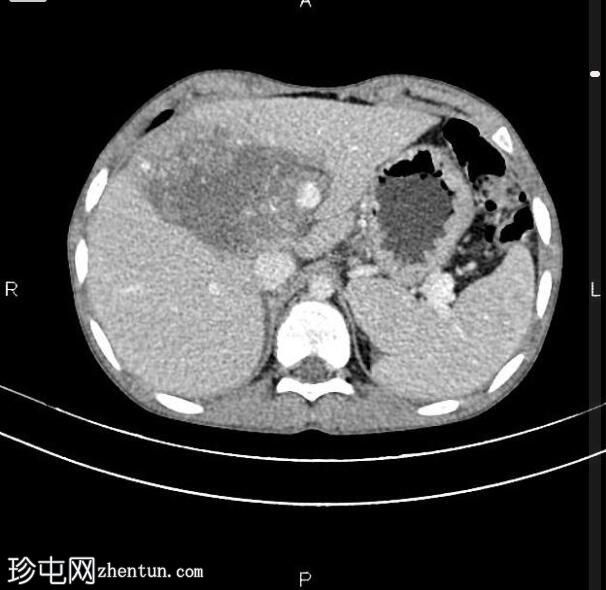 肝母细胞瘤