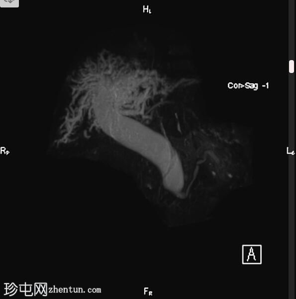 胆总管结石