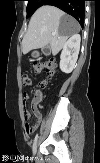 脂肪肝包虫囊肿 (CT)