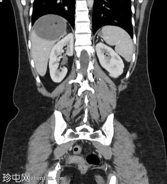 脂肪肝包虫囊肿 (CT)