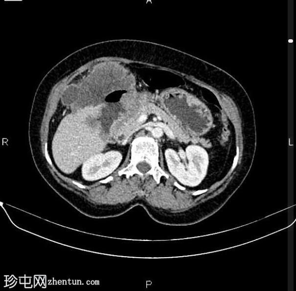 局部晚期胃十二指肠腺癌