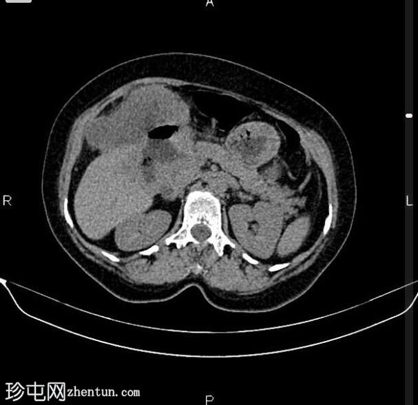 局部晚期胃十二指肠腺癌