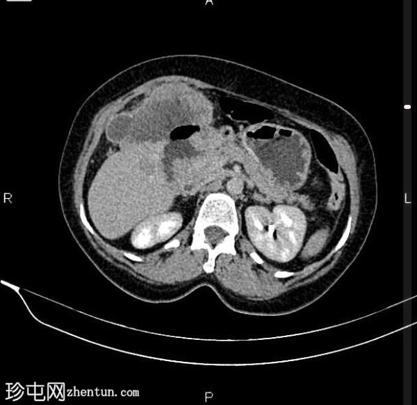 局部晚期胃十二指肠腺癌