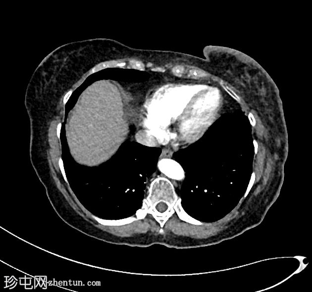 皮肤转移——乳腺癌