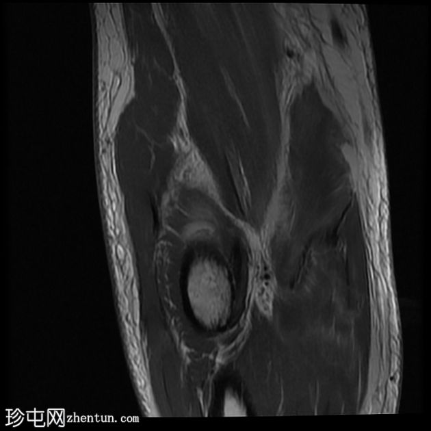 屈肌总腱和尺侧副韧带完全撕裂