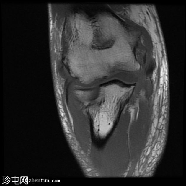 屈肌总腱和尺侧副韧带完全撕裂