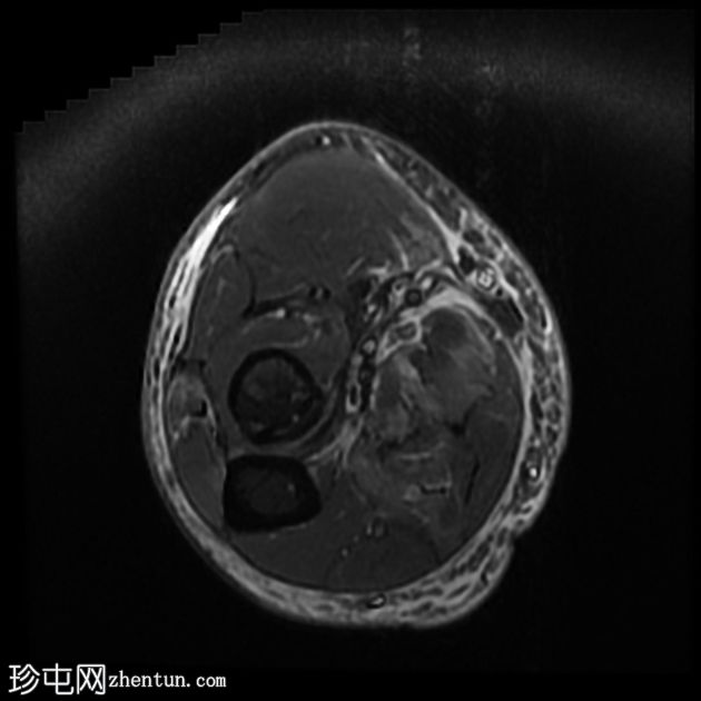 屈肌总腱和尺侧副韧带完全撕裂