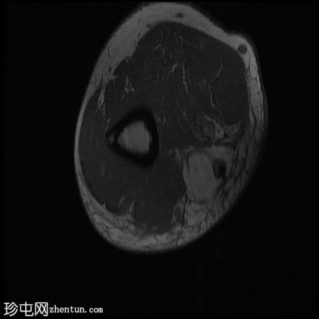 屈肌总腱和尺侧副韧带完全撕裂