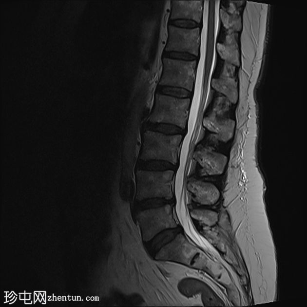 小关节关节病