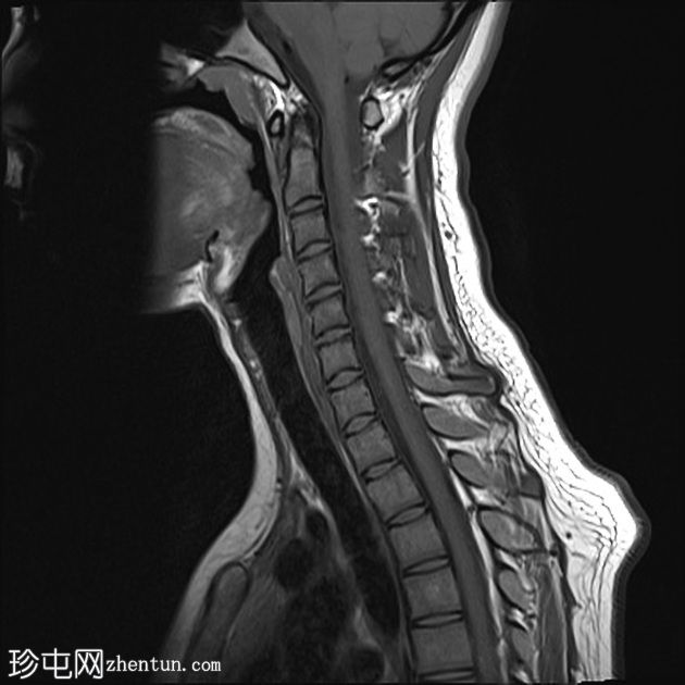 正常MRI颈椎