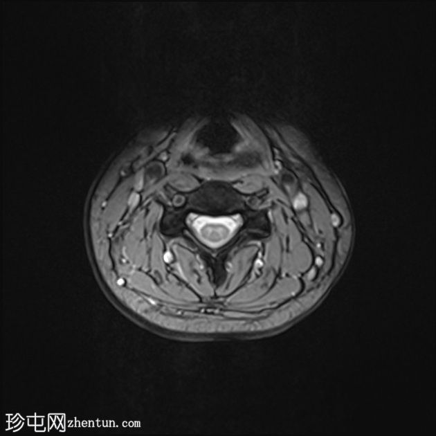 正常MRI颈椎
