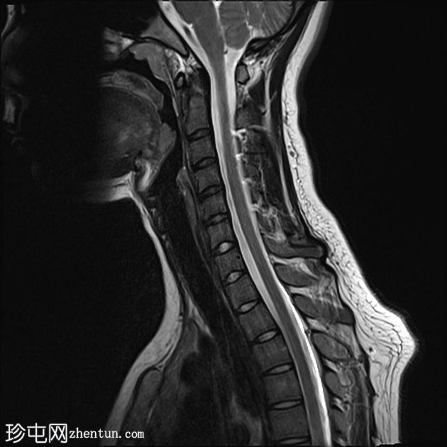 正常MRI颈椎