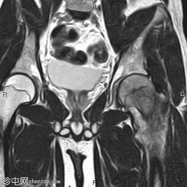 软骨母细胞性骨肉瘤 - 股骨近端