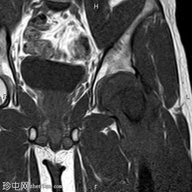 软骨母细胞性骨肉瘤 - 股骨近端