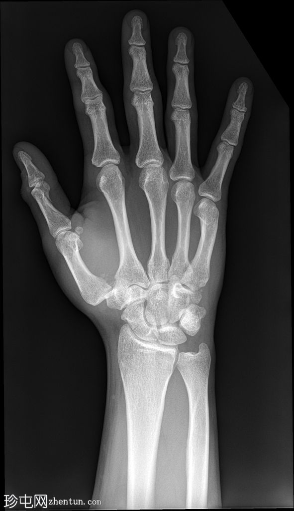 拇指骨折脱位伴腕骨和手部骨折
