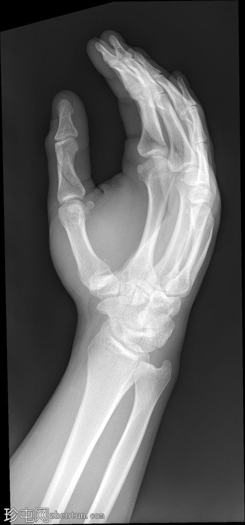 拇指骨折脱位伴腕骨和手部骨折