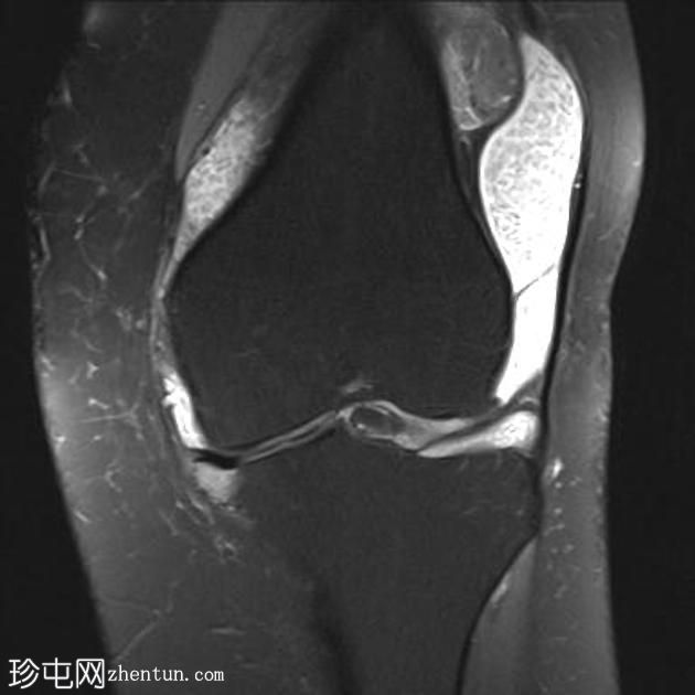 米体-膝关节滑膜软骨瘤病