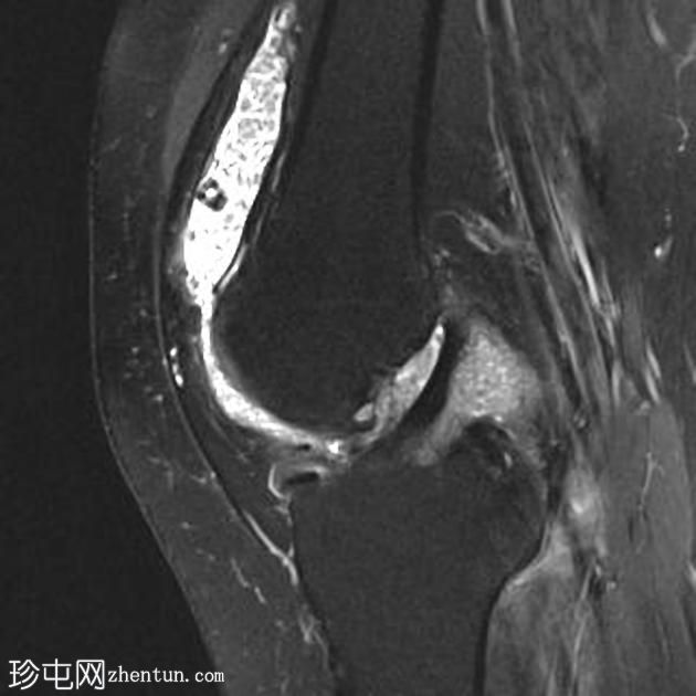 米体-膝关节滑膜软骨瘤病