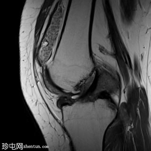 米体-膝关节滑膜软骨瘤病