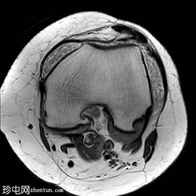 米体-膝关节滑膜软骨瘤病