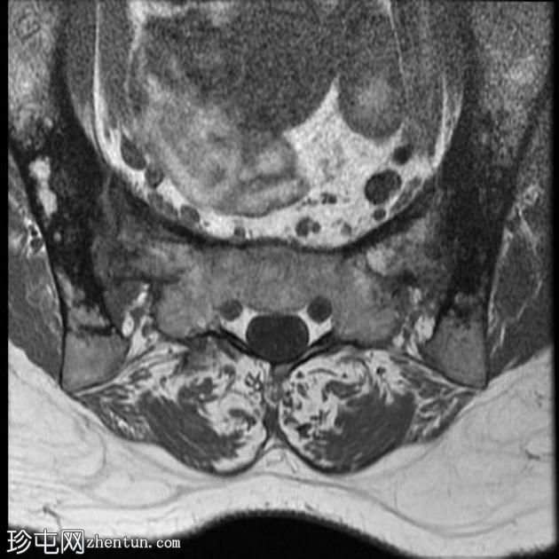 强直性脊柱炎 (MRI)