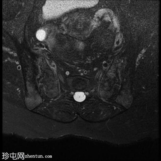 强直性脊柱炎 (MRI)