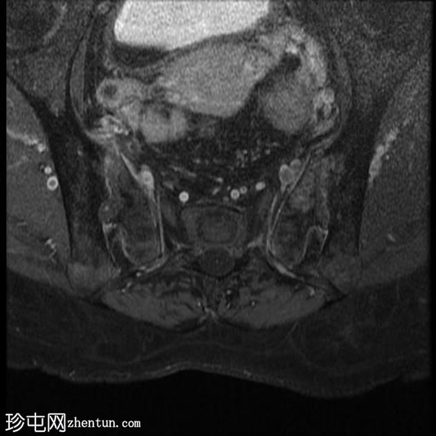 强直性脊柱炎 (MRI)