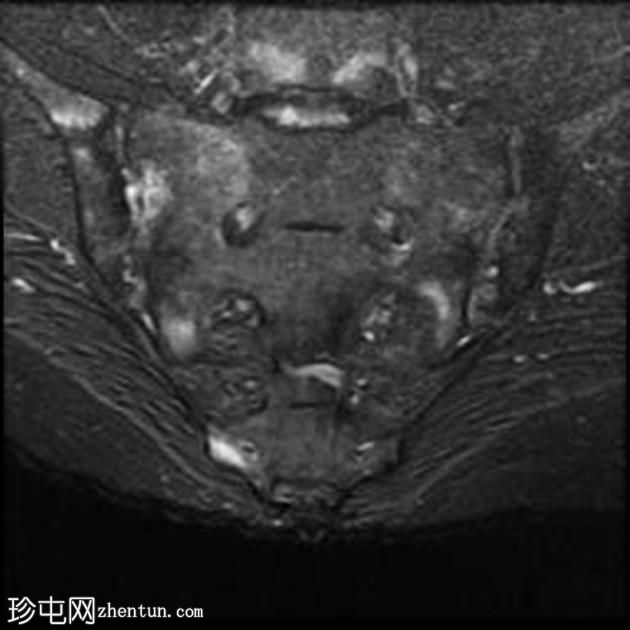 强直性脊柱炎 (MRI)