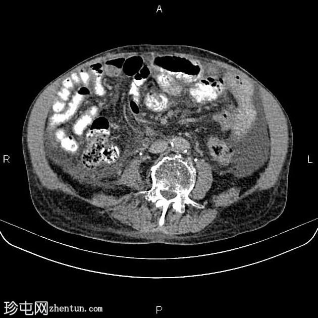 肝硬化患者的多灶性肝细胞癌