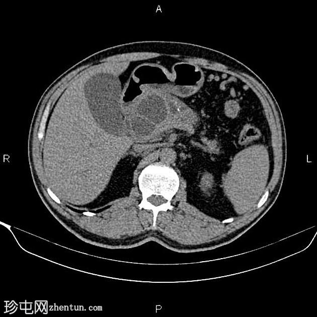 慢性胰腺炎伴假性囊肿