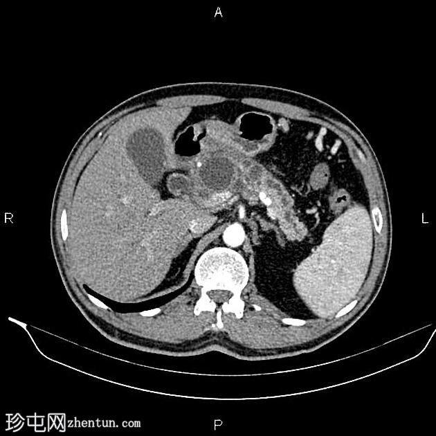 慢性胰腺炎伴假性囊肿