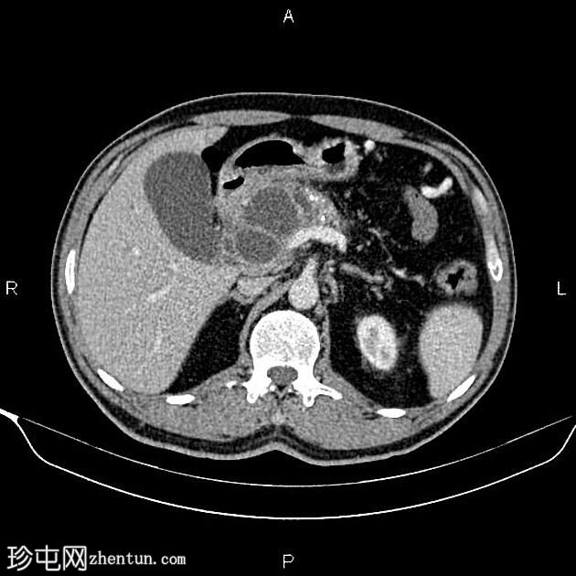 慢性胰腺炎伴假性囊肿