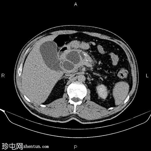 慢性胰腺炎伴假性囊肿