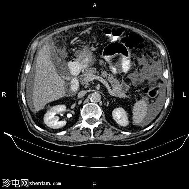 转移性胰腺导管腺癌