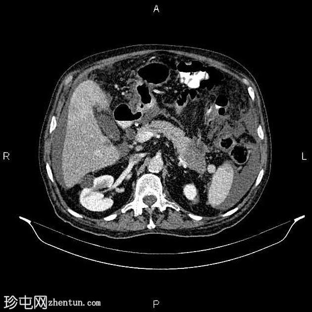 转移性胰腺导管腺癌