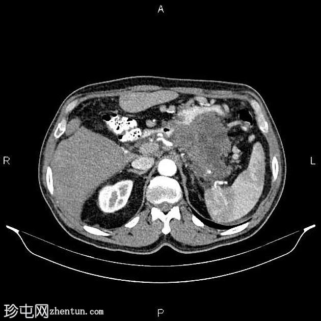 转移性胰腺导管腺癌