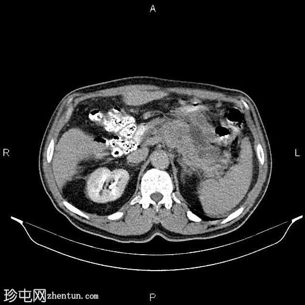 转移性胰腺导管腺癌