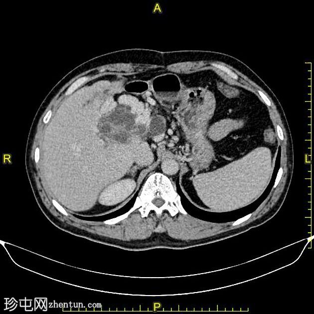 肝包虫囊肿胆内破裂