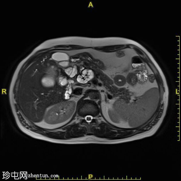 肝包虫囊肿胆内破裂