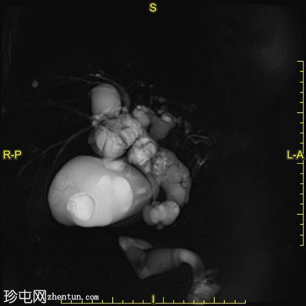 肝包虫囊肿胆内破裂