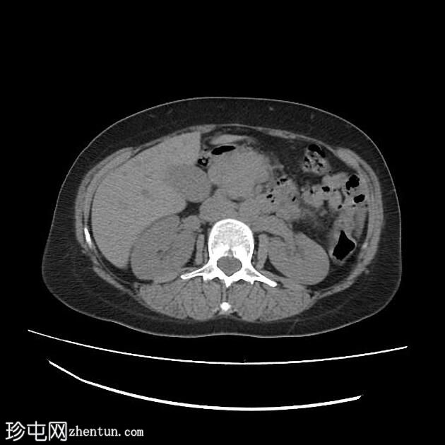 自身免疫性胰腺炎