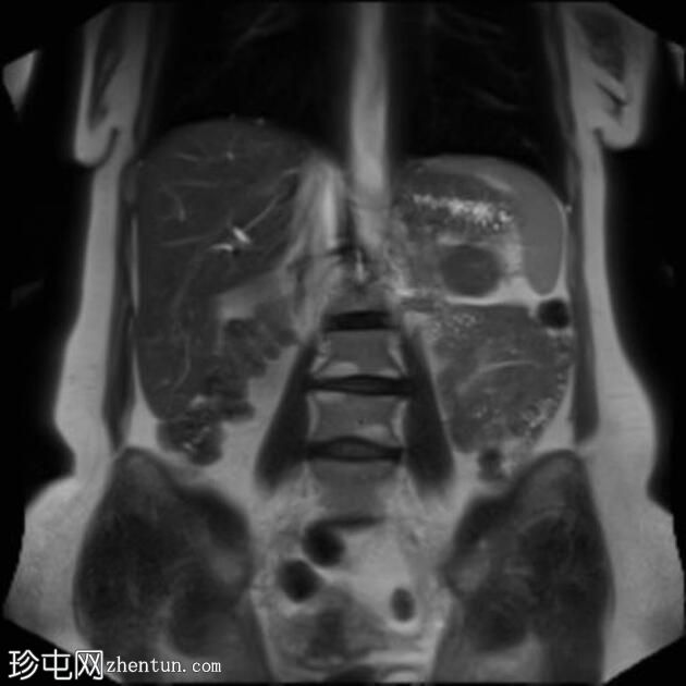 自身免疫性胰腺炎