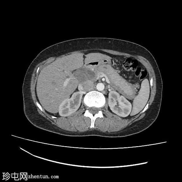 自身免疫性胰腺炎