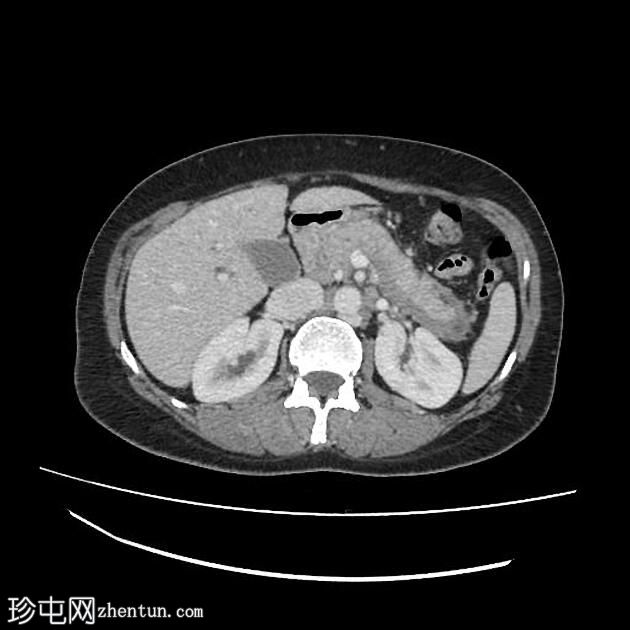 自身免疫性胰腺炎