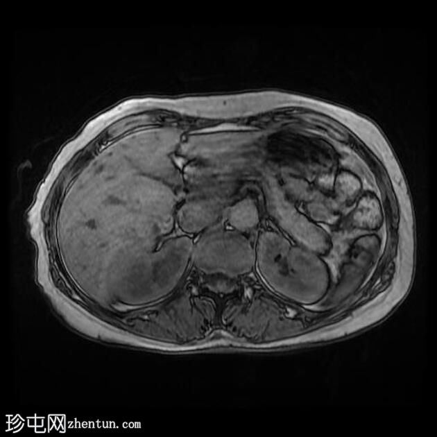 自身免疫性胰腺炎