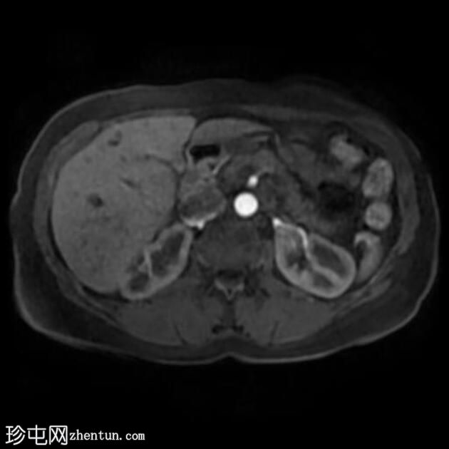 自身免疫性胰腺炎