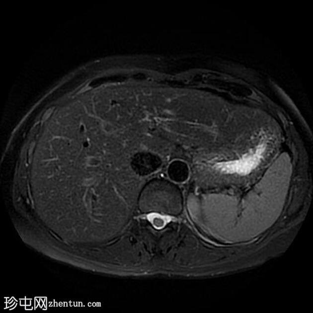 自身免疫性胰腺炎